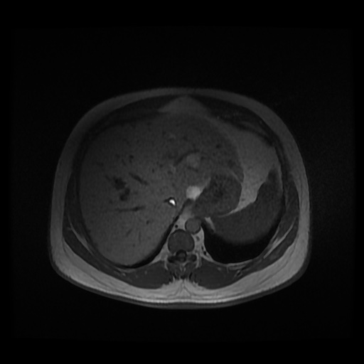 File:Autosomal dominant polycystic kidney disease (Radiopaedia 50259-55611 Axial 2D Dual Echo 22).jpg