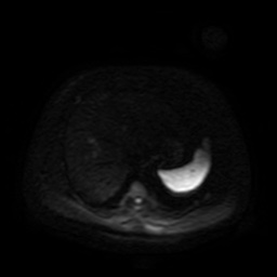 Autosomal dominant polycystic kidney disease (Radiopaedia 50259-55611 Axial DWI 80).jpg