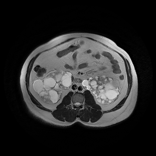 File:Autosomal dominant polycystic kidney disease (Radiopaedia 50259-55611 Axial T2 26).jpg
