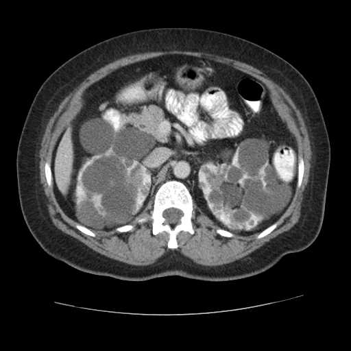 Autosomal dominant polycystic kidney disease with hepatic involvement (Radiopaedia 32693-33662 B 29).jpg