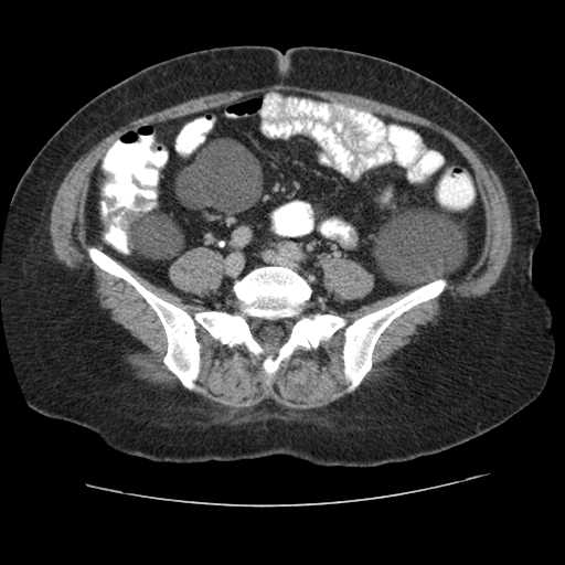 Autosomal dominant polycystic kidney disease with hepatic involvement (Radiopaedia 32693-33662 C 56).jpg