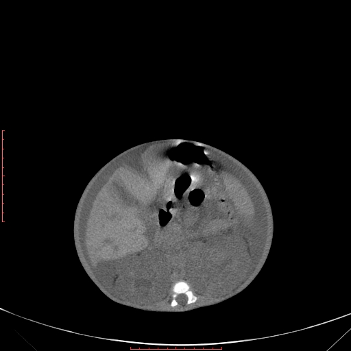 File:Autosomal recessive polycystic kidney disease associated with Caroli disease (Radiopaedia 61932-69984 Axial non-contrast 190).jpg