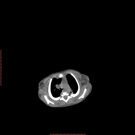 File:Autosomal recessive polycystic kidney disease associated with Caroli disease (Radiopaedia 61932-69984 Axial non-contrast 24).jpg