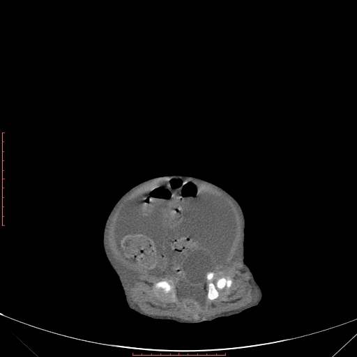 Autosomal recessive polycystic kidney disease associated with Caroli disease (Radiopaedia 61932-69984 B 326).jpg