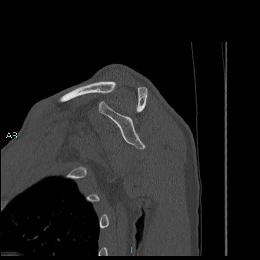 Avascular necrosis after fracture dislocations of the proximal humerus (Radiopaedia 88078-104655 Sagittal bone window 38).jpg