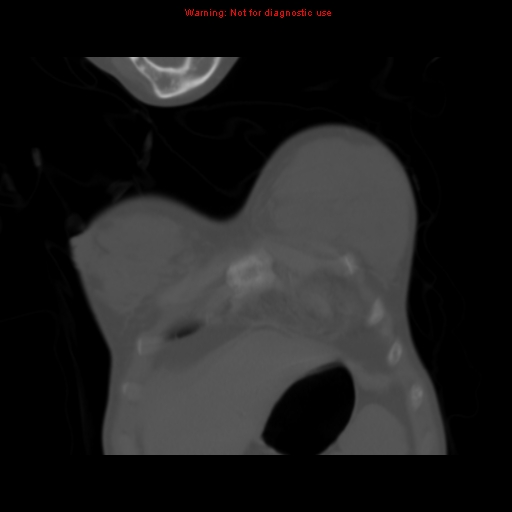 File:Avascular necrosis in sickle cell disease (Radiopaedia 17448-17152 Coronal bone window 12).jpg