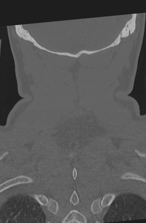 Axis peg fracture (type 3) and atlas lateral mass (type 4) fracture (Radiopaedia 37474-39324 Coronal bone window 56).png