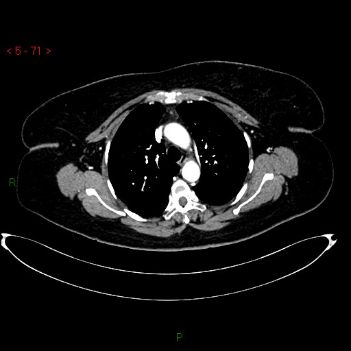Azygos fissure and lobe (Radiopaedia 47620-52278 A 57).jpg