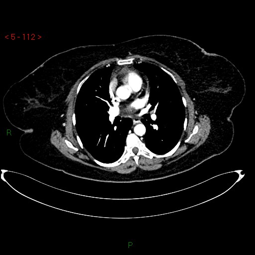 File:Azygos fissure and lobe (Radiopaedia 47620-52278 A 98).jpg