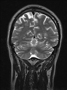File:Balo concentric sclerosis (Radiopaedia 50458-55940 Coronal T2 41).jpg