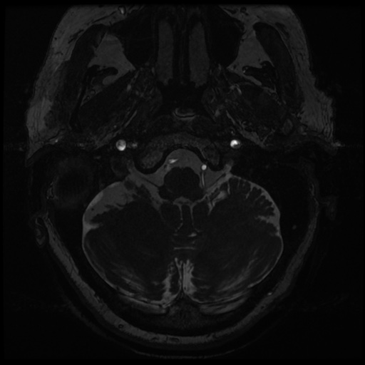 File:Balo concentric sclerosis (Radiopaedia 53875-59982 Axial T2 FIESTA 9).jpg