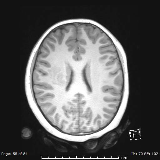 Balo concentric sclerosis (Radiopaedia 61637-69636 Axial T1 55).jpg