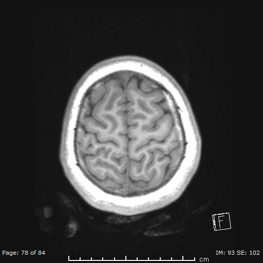 Balo concentric sclerosis (Radiopaedia 61637-69636 Axial T1 78).jpg