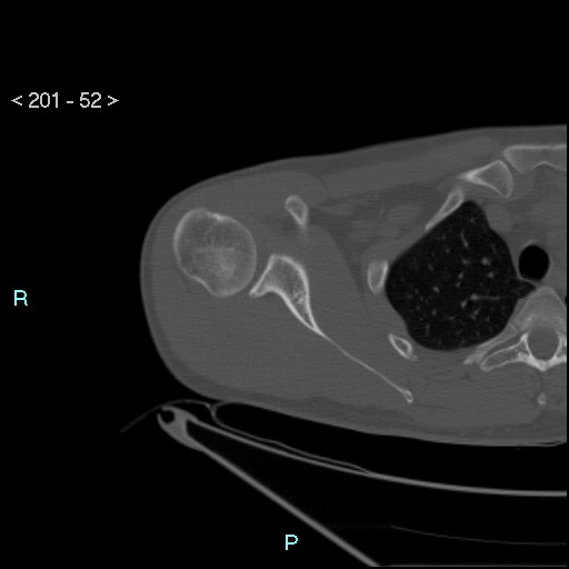 Bankart lesion with glenoid bone defect - assessment TC with PICO method (Radiopaedia 42855-93901 Axial bone window 51).jpg