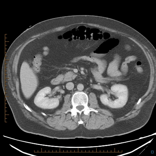 File:Bariatric balloon causing gastric outlet obstruction (Radiopaedia 54449-60672 A 18).jpg