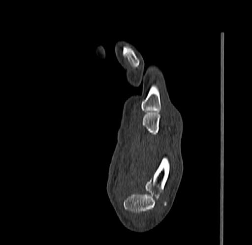 Base of 2nd metacarpal fracture (Radiopaedia 73741-84544 Sagittal bone window 60).jpg
