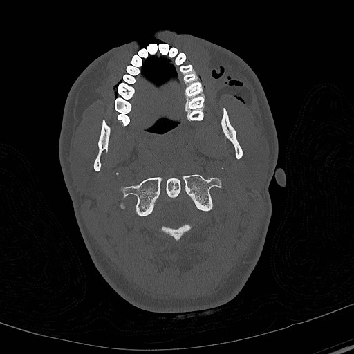 Base of skull fracture with bilateral Le Fort fractures (Radiopaedia 47094-51638 Axial bone window 11).jpg