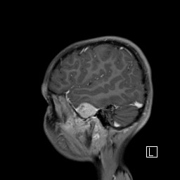 Base of skull rhabdomyosarcoma (Radiopaedia 32196-33142 J 15).jpg