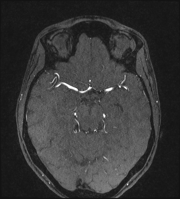 Basilar artery perforator aneurysm (Radiopaedia 82455-97733 Axial MRA 105).jpg