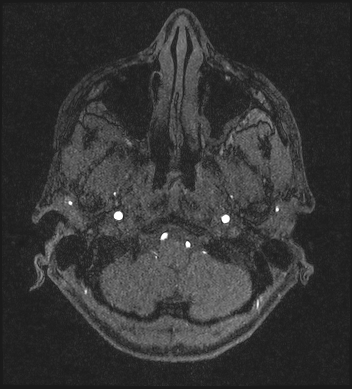 Basilar artery perforator aneurysm (Radiopaedia 82455-97733 Axial MRA 31).jpg