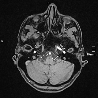Basilar artery perforator aneurysm (Radiopaedia 82455-99523 F 18).jpg