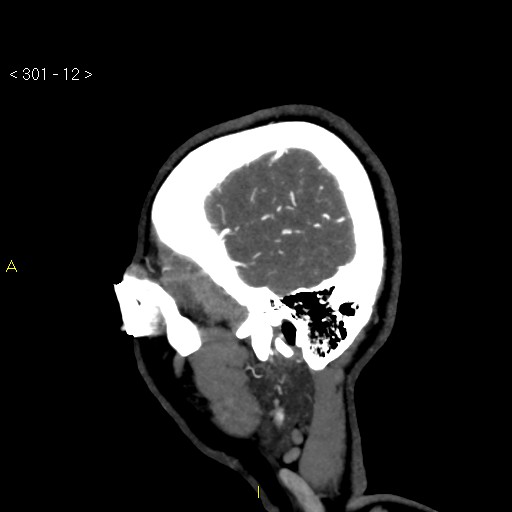 File:Basilar artery thrombosis (Radiopaedia 16260-15944 C 6).jpg