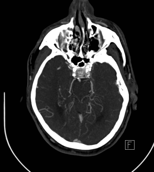 File:Basilar artery thrombosis (Radiopaedia 26986-27163 A 36).jpg