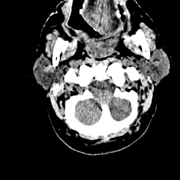 Basilar artery thrombosis (Radiopaedia 53351-59352 Axial non-contrast 15).jpg
