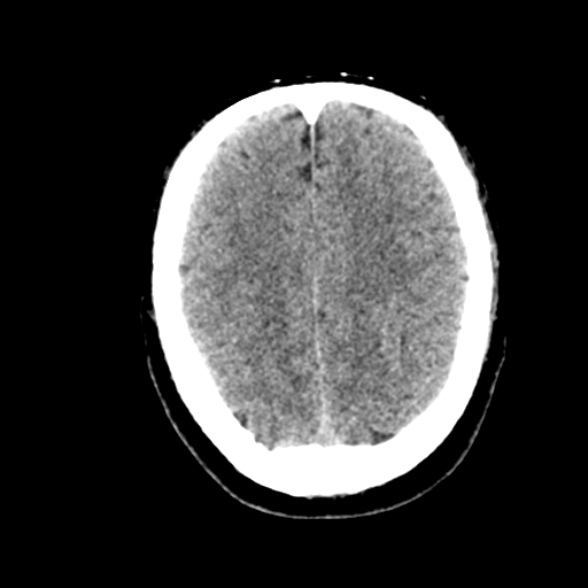 Basilar artery thrombosis (Radiopaedia 53351-59352 Axial non-contrast 89).jpg