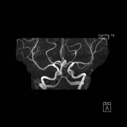 Basilar tip aneurysm (Radiopaedia 26504-26632 D 33).jpg