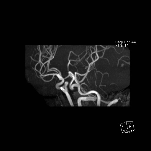 Basilar tip aneurysm (Radiopaedia 26504-26632 D 48).jpg