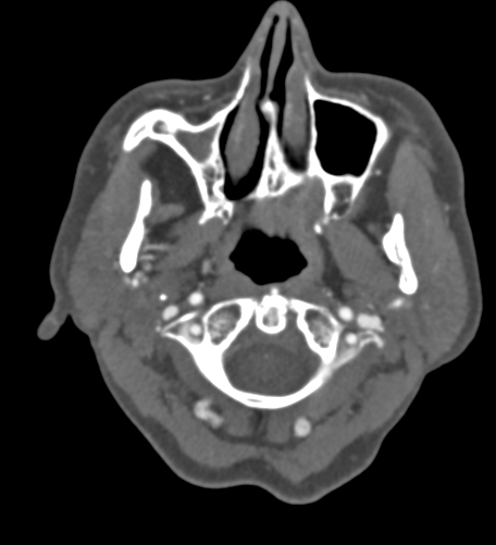 File:Basilar tip aneurysm with coiling (Radiopaedia 53912-60086 A 5).jpg