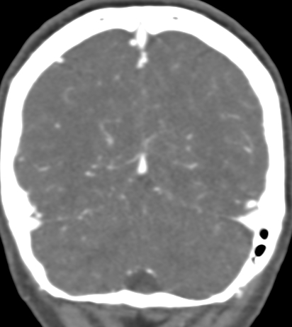Basilar tip aneurysm with coiling (Radiopaedia 53912-60086 B 125).jpg