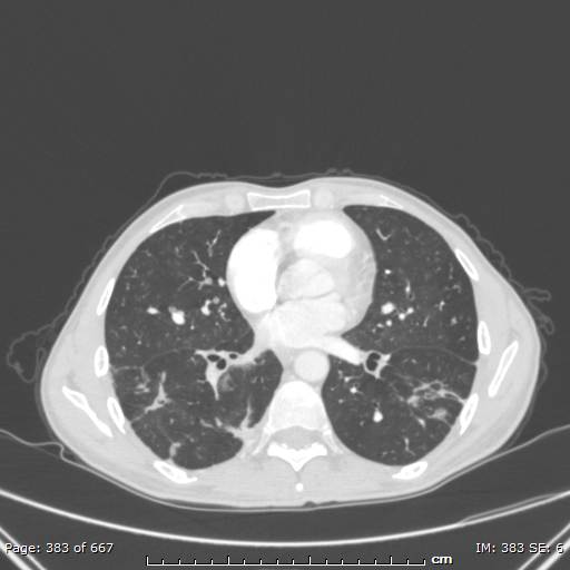 Behçet disease (Radiopaedia 44247-47889 Axial lung window 51).jpg