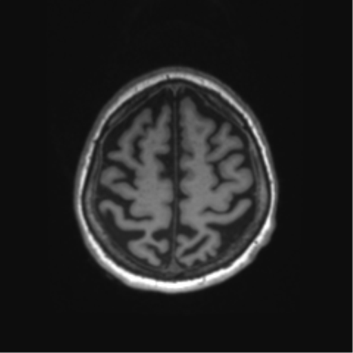 Behavioral variant frontotemporal dementia and late onset schizophrenia (Radiopaedia 52197-58083 Axial T1 10).png