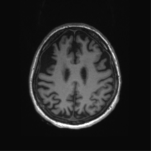 Behavioral variant frontotemporal dementia and late onset schizophrenia (Radiopaedia 52197-58083 Axial T1 25).png