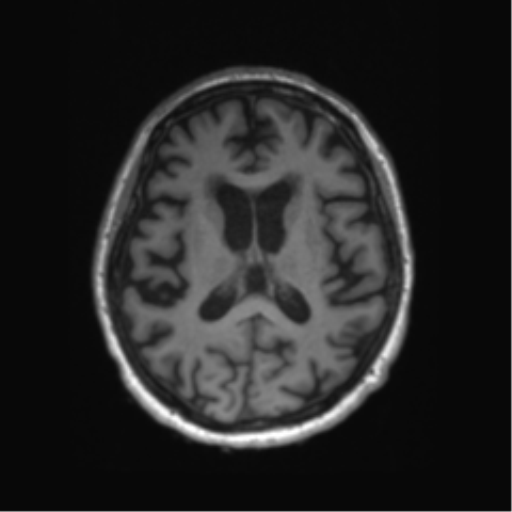 File:Behavioral variant frontotemporal dementia and late onset schizophrenia (Radiopaedia 52197-58083 Axial T1 41).png