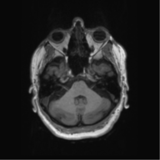 Behavioral variant frontotemporal dementia and late onset schizophrenia (Radiopaedia 52197-58083 Axial T1 86).png