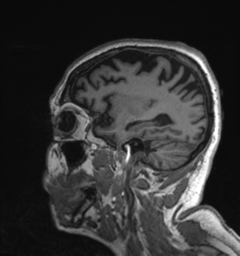 Behavioral variant frontotemporal dementia and late onset schizophrenia (Radiopaedia 52197-58083 Sagittal T1 18).png