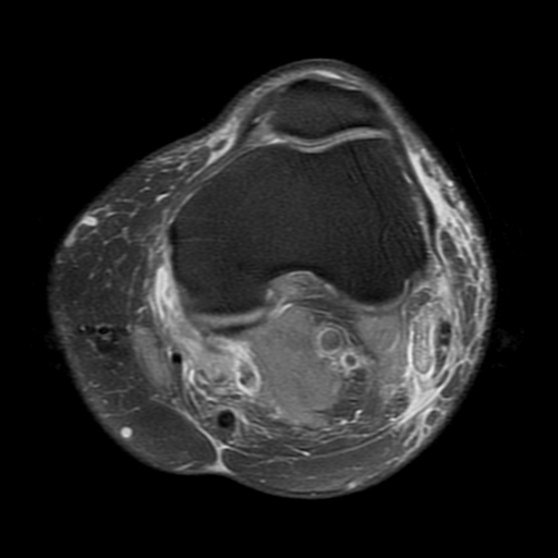 File:Biceps femoris distal tendon avulsion (Radiopaedia 15109-14987 Axial PD fat sat 9).jpg