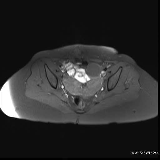 File:Bicornuate uterus- on MRI (Radiopaedia 49206-54297 Axial T1 fat sat 11).jpg
