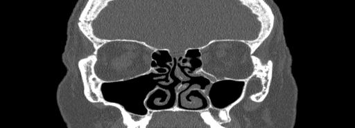 Bilateral Ectopic Infraorbital Nerves (Radiopaedia 49006-54084 Coronal bone window 31).jpg