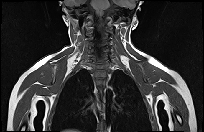 File:Bilateral Sprengel deformity with Klippel-Feil syndrome (Radiopaedia 66395-75650 Coronal T1 14).jpg