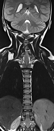 File:Bilateral Sprengel deformity with Klippel-Feil syndrome (Radiopaedia 66395-75650 F 7).jpg
