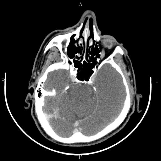 Bilateral Warthin tumors (Radiopaedia 84034-99263 Axial With contrast 2).jpg