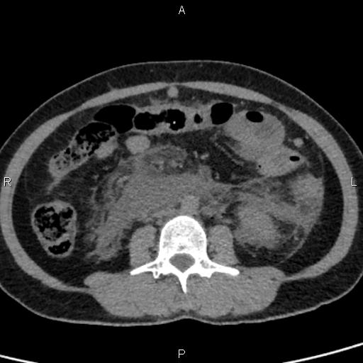 Bilateral adrenal gland hyperenhancement in pancreatitis (Radiopaedia 86642-102753 Axial non-contrast 62).jpg