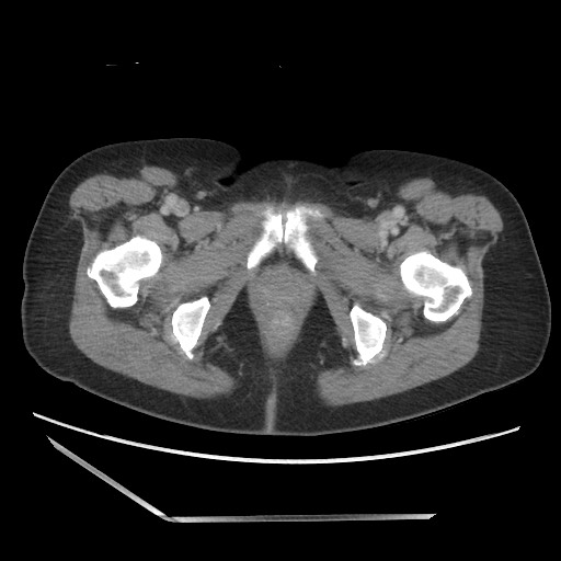 Bilateral adrenal granulocytic sarcomas (chloromas) (Radiopaedia 78375-91007 A 122).jpg