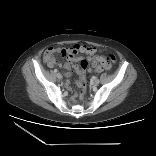 Bilateral adrenal granulocytic sarcomas (chloromas) (Radiopaedia 78375-91007 A 92).jpg