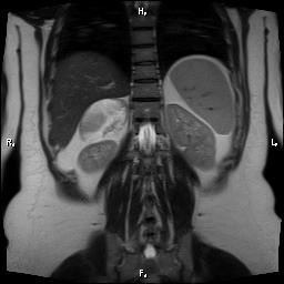 File:Bilateral adrenal myelolipoma (Radiopaedia 63058-71537 Coronal T2 6).jpg