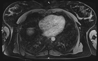 File:Bilateral adrenal myelolipoma (Radiopaedia 63058-71537 H 4).jpg